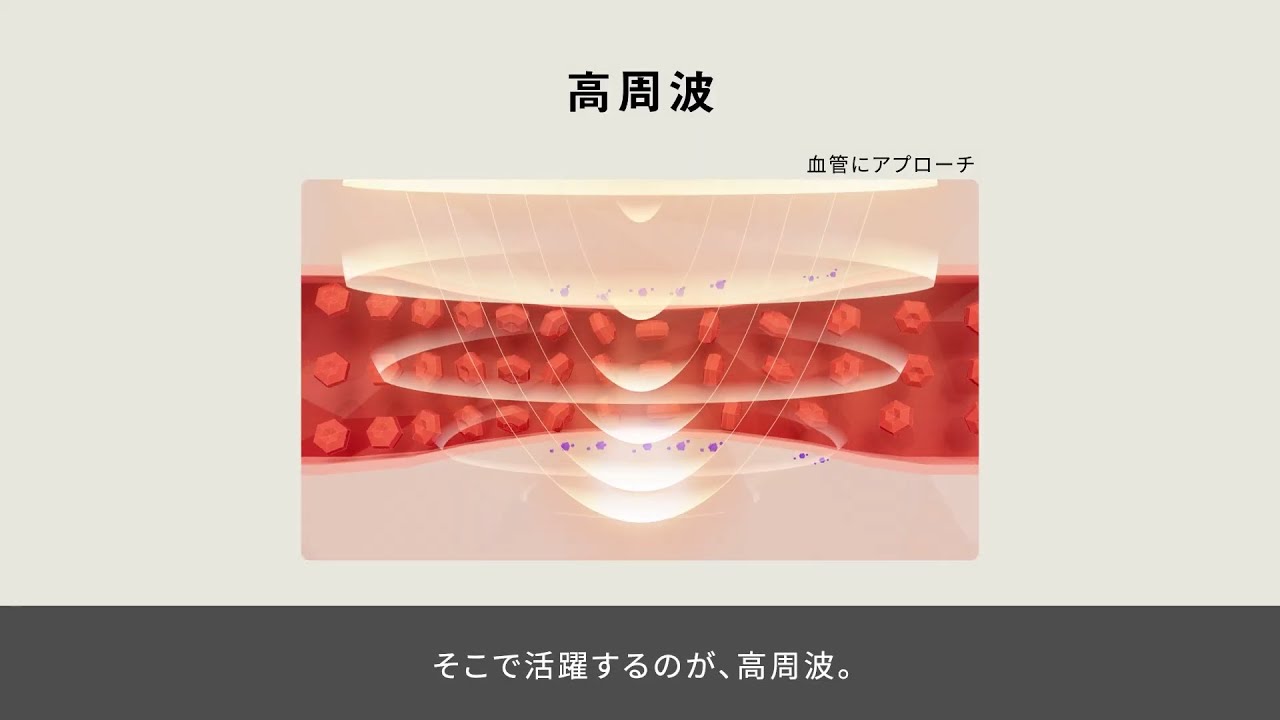 コリコランワイド3D（肩専用）の技術 | 特長 高周波治療器 コリコラン