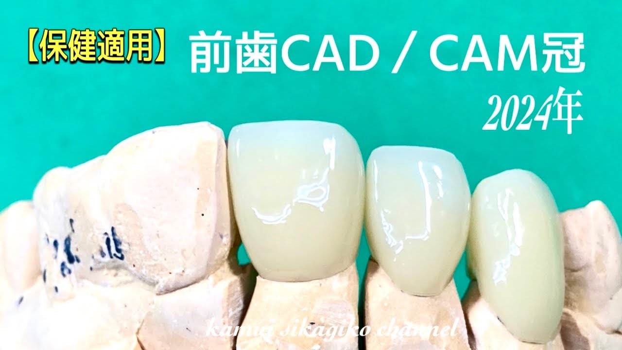 【歯科技工士】初めて作る保健で出来る前歯CAD／CAM冠【exocad3.1】 - YouTube