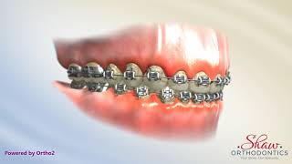 Shaw Orthodontics Decalcification