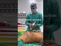 Advanced PAL Liposuction in Pune | Vibrasat Pro Technology | 9834655013