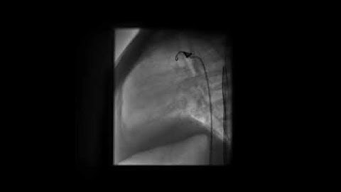 Small PDA   Post coil closure