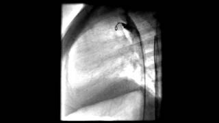 Small Pda Post Coil Closure