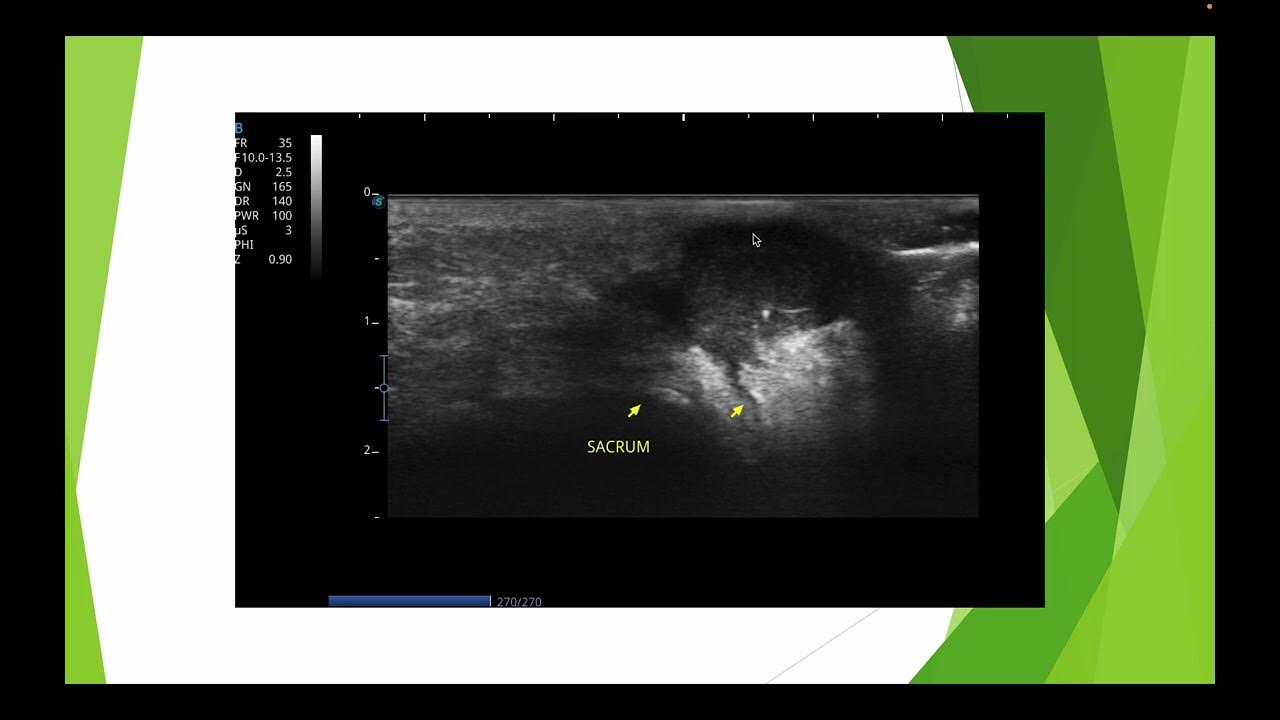 Aspect typique du kyste pilonidal en échographie YouTube