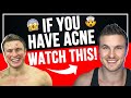 How To HACK Your Confidence With Acne!