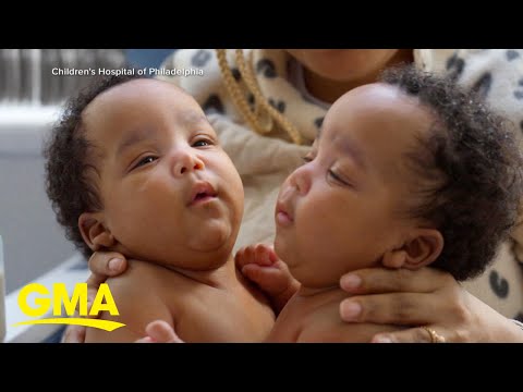 Formerly conjoined twin brothers go home for 1st time