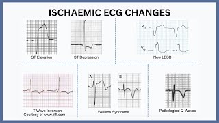 Ischaemic ECG Changes Explained