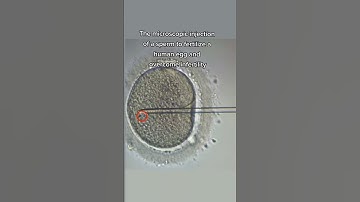 injecting a sperm into a human egg to overcome infertility