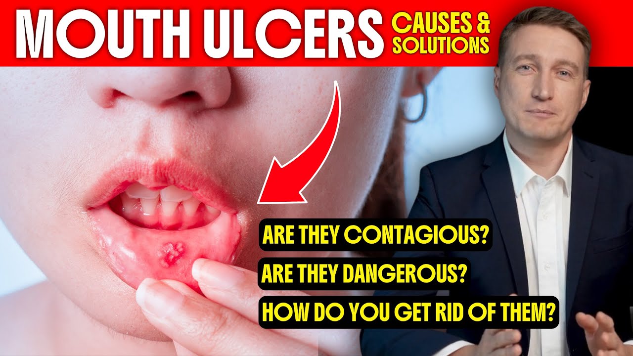 Mouth Ulcers: Causes and Solutions. Are They Contagious or Dangerous? How to Get Rid of Them?