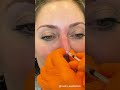 Nonsurgical rhinoplastynose job  la  westside aesthetics  alexander rivkin md