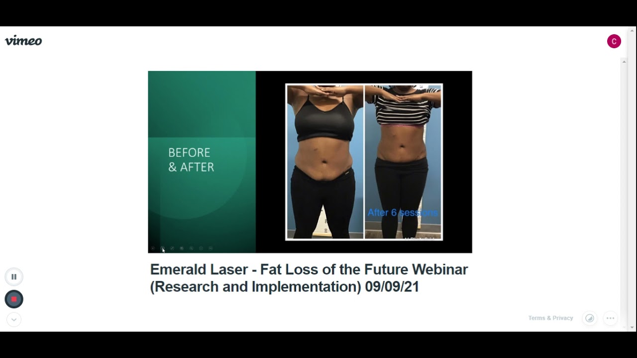 Emerald Laser Fat Loss Before & After Pix YouTube