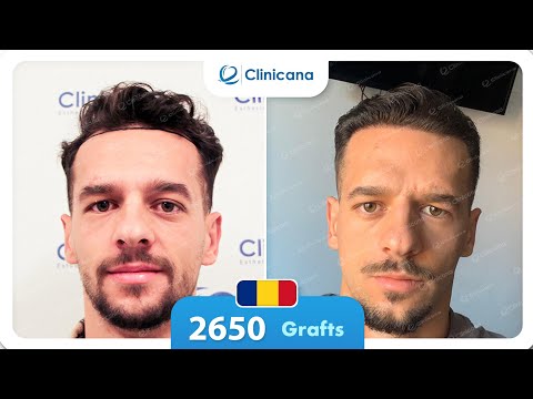 Bogdan’s hair transplant