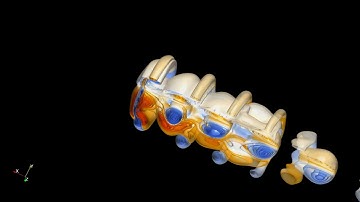 CFD simulation of Jellyfish swimming. Algorithm: immersed boundary method. Vortex: Lamda2.