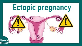 Ectopic Pregnancy | What is the main cause of ectopic pregnancy | Treatment of ectopic pregnancy