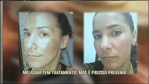 O que pode ser manchas escuras no rosto?
