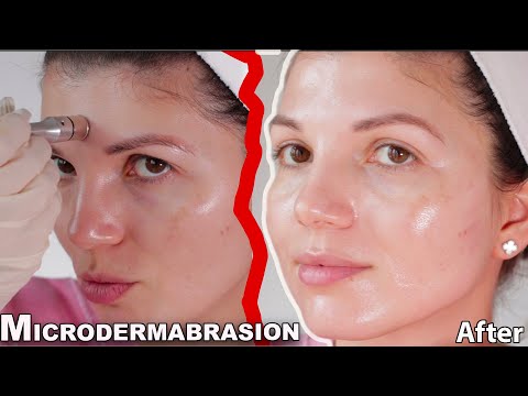 MICRODERMABRASION at home (2021)- skin expert FULL procedure and before and after results