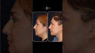 SignatureSculpt® Rhinoplasty Explained | Dr. Jason Champagne, Beverly Hills