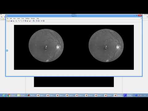 Automated Microaneurysms Detection in Fundus Images Using Image Segmentation in Matlab