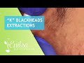 Blackheads Extractions “K’s” 2nd Treatment