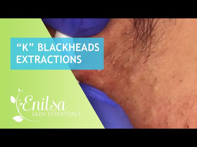 Blackheads Extractions “K’s” 2nd Treatment class=