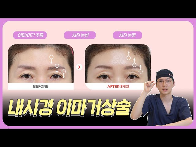 내시경 이마거상술, 이마 리프팅을 통해 눈을 조금 더 시원하게!👍 에이탑성형외과/ATOP plastic surgery(feat:손승태원장)
