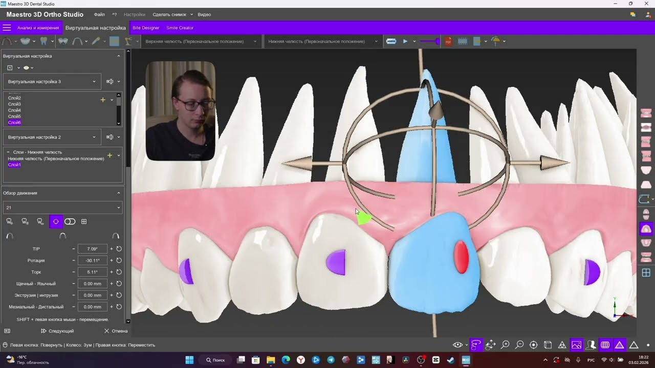 Моделирование элайнеров в Maestro 3D | Ротация, скученность