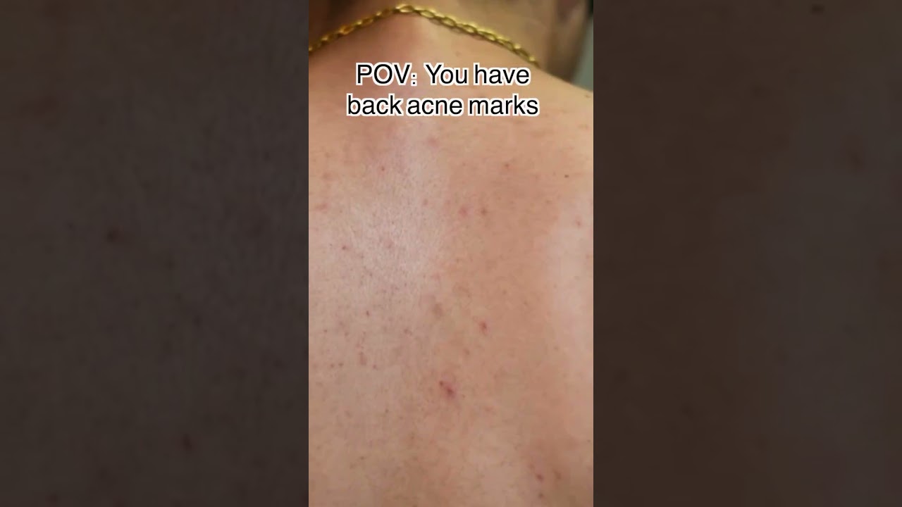 How To Prevent Back Acne? | Dr. Sarin |