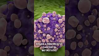 New Hope for Stage 4 Pancreatic Cancer!