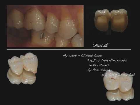 Esthetic Restorations by Wei-Chih Cheng.mov