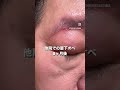 眉下切開の当院と他院の比較動画