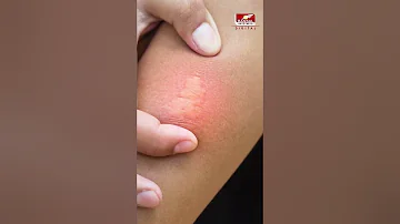 मधुमक्खी काटने पर उपचार के घरेलू नुस्खे - Honey Bee Bite Treatment | Home Remedies