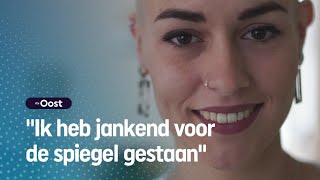 Melissa 23 Gaat Kaal Door Het Leven Ze Heeft Alopecia Rtv Oost