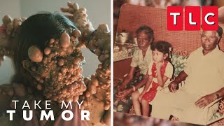 The History of Charmaine's Tumors | Take My Tumor | TLC