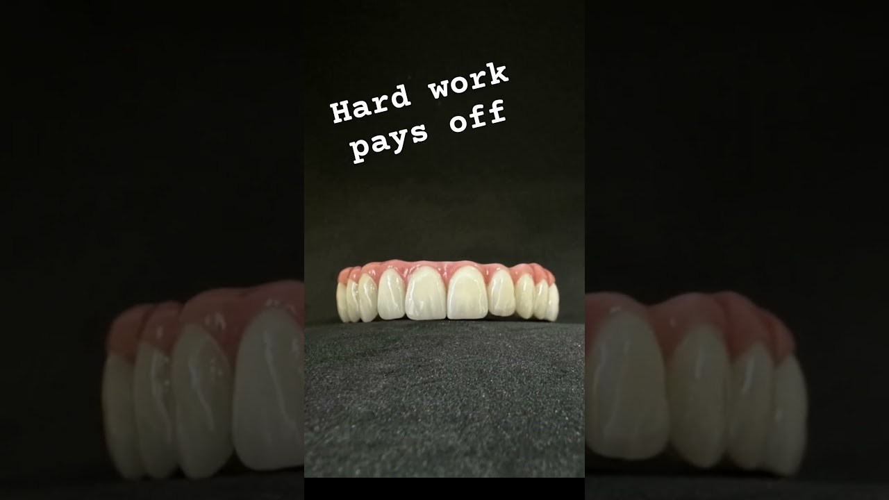 Full arch zirconia with titanium bar 