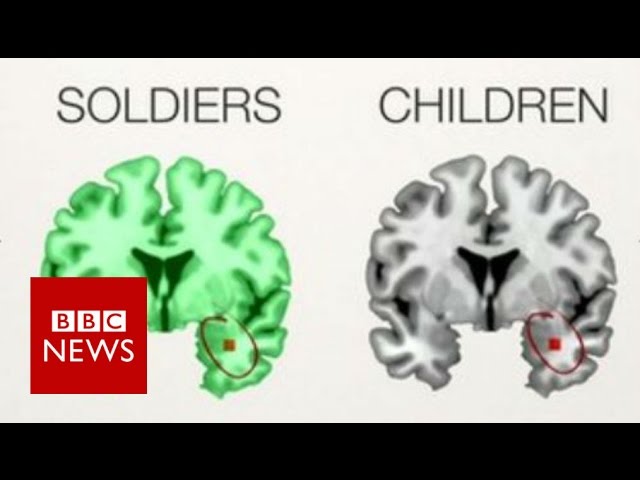 The PTSD brains of children & soldiers - BBC News class=