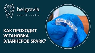 👄  Как проходит установка элайнеров Spark?