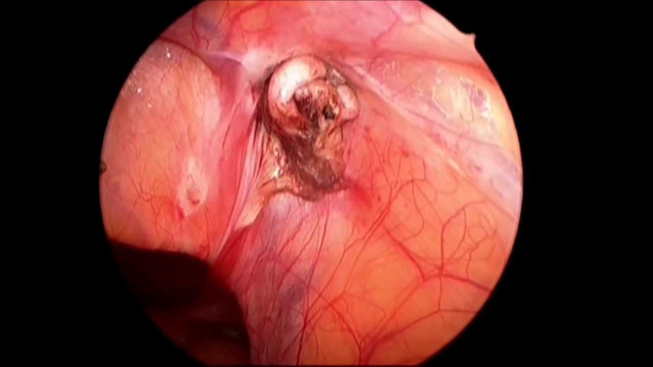 Pediatric Laparoscopic Inguinal Hernia Repair: A Review of