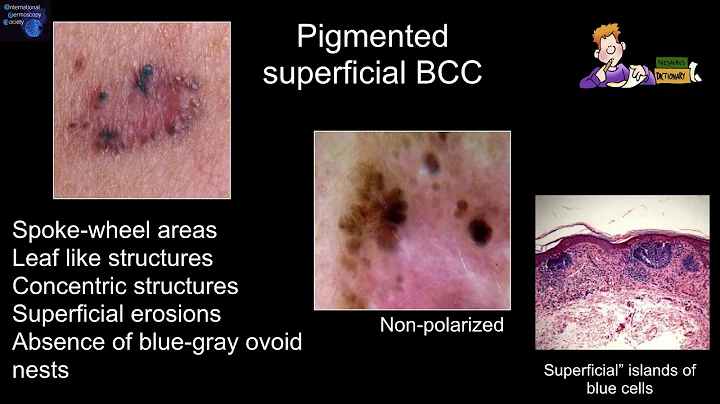 Dermoscopy features associated with subtypes of basal cell carcinomas - Dr. Harold S. Rabinovitz