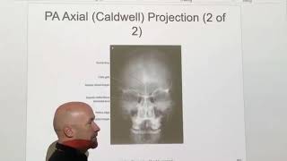 Facial bones- Waters Method, Caldwell Method, and Submentovertical (SMV) projection Content