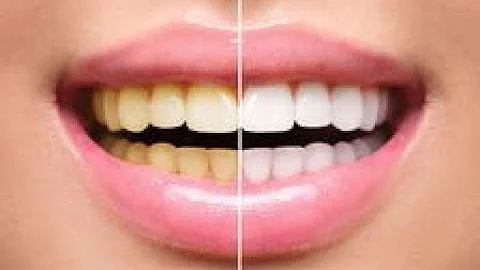 ¿Qué efecto tiene el peróxido de hidrógeno en los dientes?