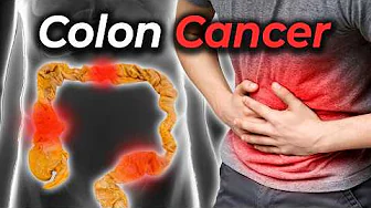 Got Screened for Colon Cancer, Here's How to Prevent It