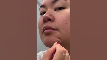 How Do Pimple Patches Work? #pimples  #acnetreatment #pimplepatch