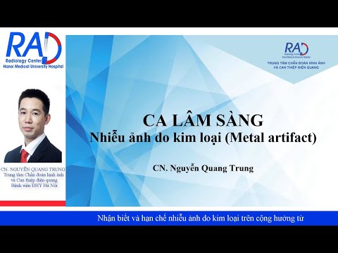 Nhiễu Trong Truyền Thông Là Gì - Nhận biết và hạn chế nhiễu ảnh do kim loại trên cộng hưởng từ