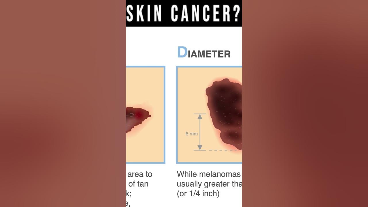 what-does-skin-cancer-look-like-symptoms-pictures-types-youtube
