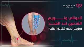 الدوالي وانتفاخ القدمين دليل على مرض القلب | دكتور سامح علام