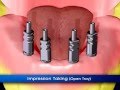 Протезирование на нижнюю челюсть с помощью имплантатов ADIN