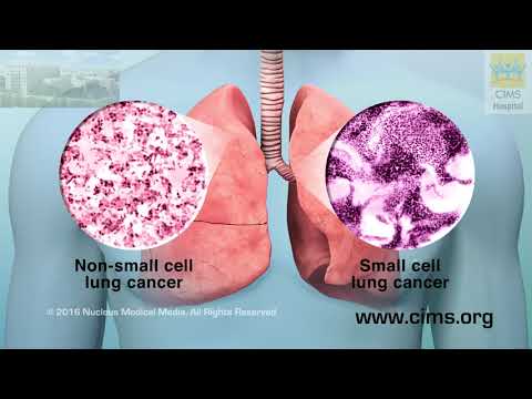 Understanding Lung Cancer (Hindi)– CIMS Hospital