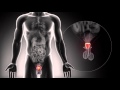 Treatment Options for Localized Prostate Cancer - Urology Care Foundation