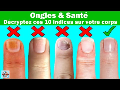 Vidéo: Pourquoi la lunule a un aspect blanchâtre ?