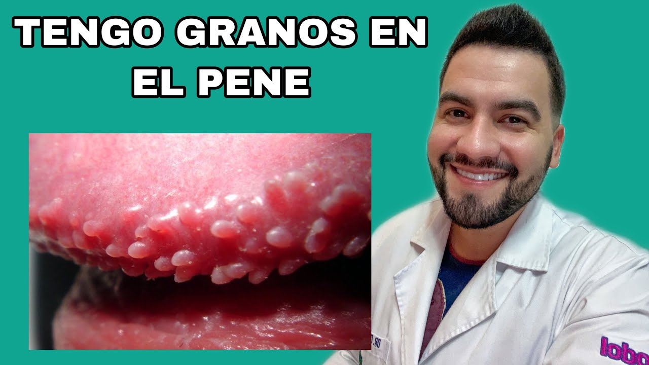 Tengo Unos Granitos En El Pene Papulas Perladas O Glandulas De Tyson Dr David Campos Youtube