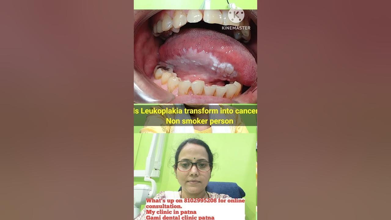 white-patch-in-mouth-leukoplakia-in-non-smokers-leukoplakia-smoking